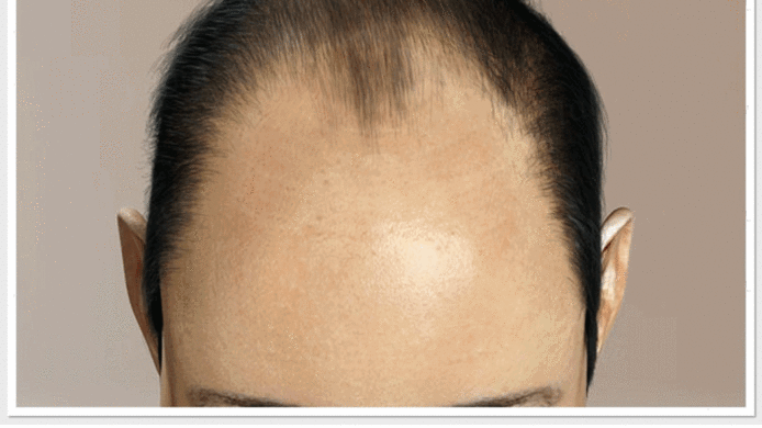 Hair Loss Male Pattern