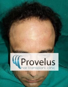 Turban Alopecia Hair Loss affects fron and sides more than Top