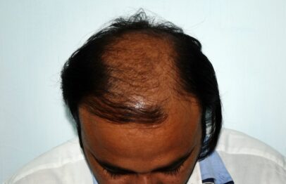 Shock loss after hair transplant