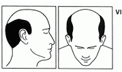 Stage six of male hair loss