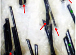 Hair Follicle miniaturisation picture on videomicroscope