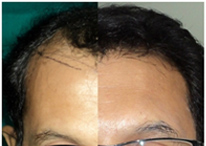 Permanent Hair Transplant for hair loss