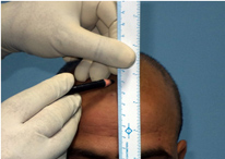 Drawing a hair line for hair transplant