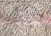 Trichophytic closure showing hair growth from strip scar after hair transplant