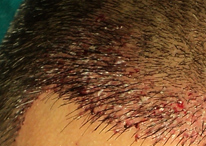 Hair Transplant area fresh after follicle implantation of 2500 grafts