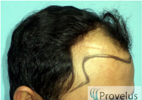 Hairline design for FUE hair transplantation