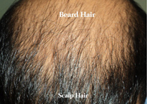 Body hair transplant results