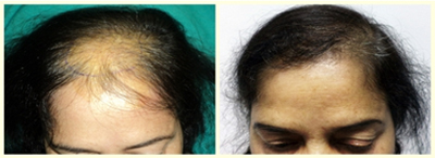 Women hair transplant results