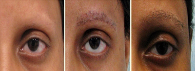 Eyebrow transplant results in alopecia