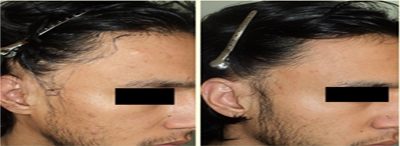 Sideburns hair transplant for turban alopecia