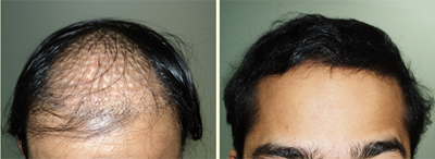 Repair for complicated hair transplant
