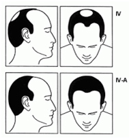 Stage four of male hair loss