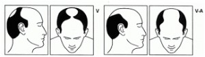 Stage five of male hair loss
