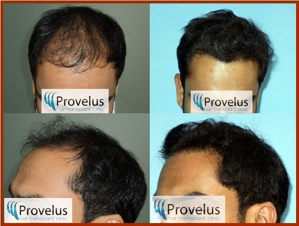 affordable hair transplant in delhi india